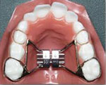 Teeth expander