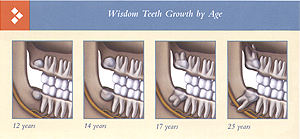 The Facts About Wisdom Teeth