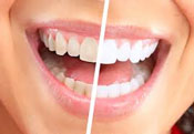 Straight Scoop on Whitening Teeth