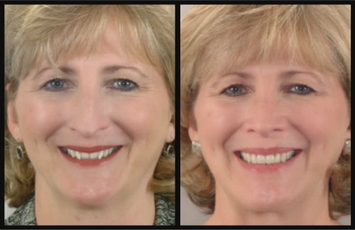 Reverse The Aging Process With A New Smile By Reynolds & Stoner Orthodontics