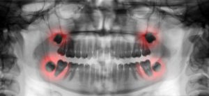 Teeth X-ray