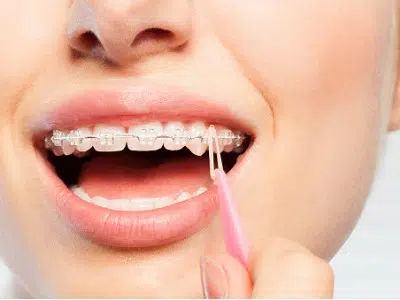 Woman Showing teeth aligners