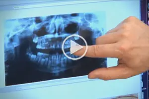 Early Orthodontic Treatment Video Thumbnail