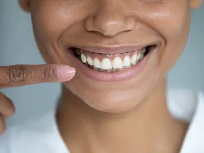 Woman Showing teeth aligners