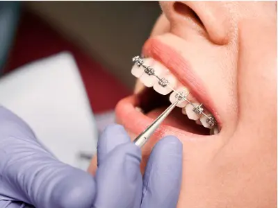 Teeth aligners