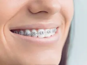 Beautiful smiling with showing braces